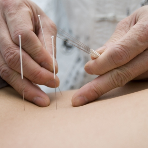 Dry-needling-Elliott-Physical-Therapy-MA